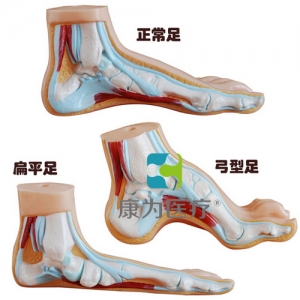 “康為醫(yī)療”正常足、扁平足、弓型足模型