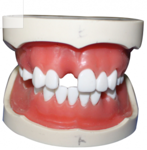 種植牙模型（含上、下頜）