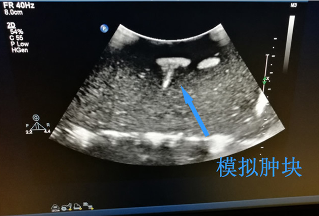 超聲引導下頸部體表腫塊活檢模塊